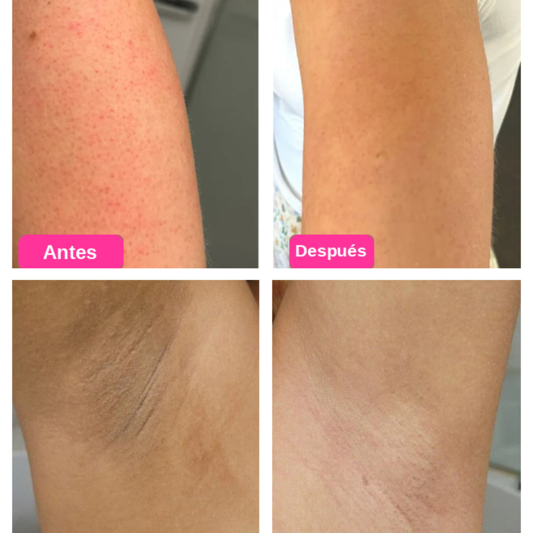 Peel Shot™ - Exfoliante Corporal Aclarante